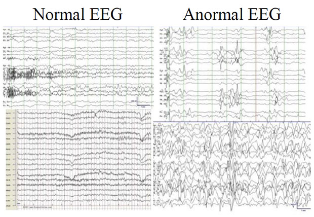 eeg-hakkinda-temel-bilgiler-3-v2.jpg